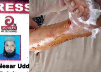 Journalist Nesar’s Treatment Crisis: Treatment Halted Due to Lack of Funds, Infection Spreads in His Leg